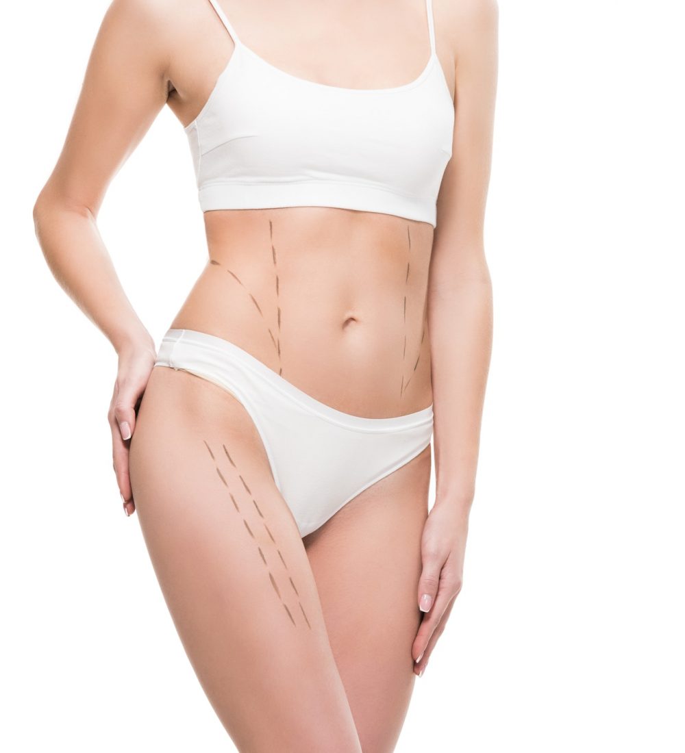 cropped shot of young woman in white underwear with correction marks on body isolated on white